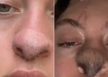 Após mordida de cão, mulher faz cirurgia no nariz e cabelos crescem na região